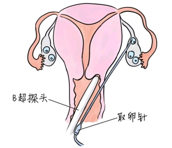 小儿退烧推拿手法 5种无锡捐卵宝宝退烧按摩方法